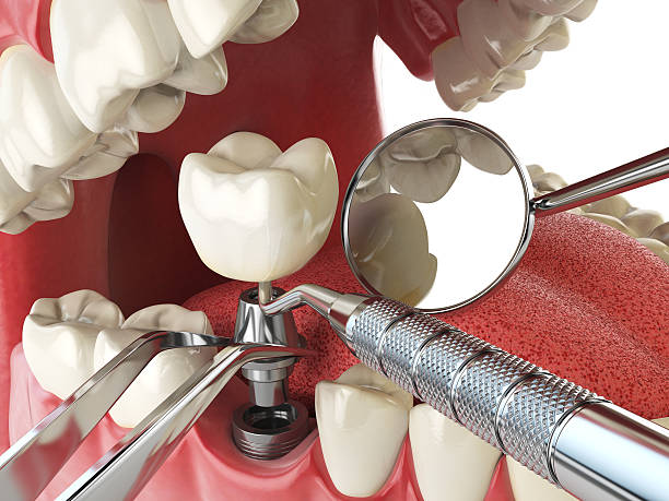 Best Emergency Root Canal Treatment in Bryan, TX